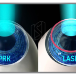 LASIK and PRK Vision Correction Procedures