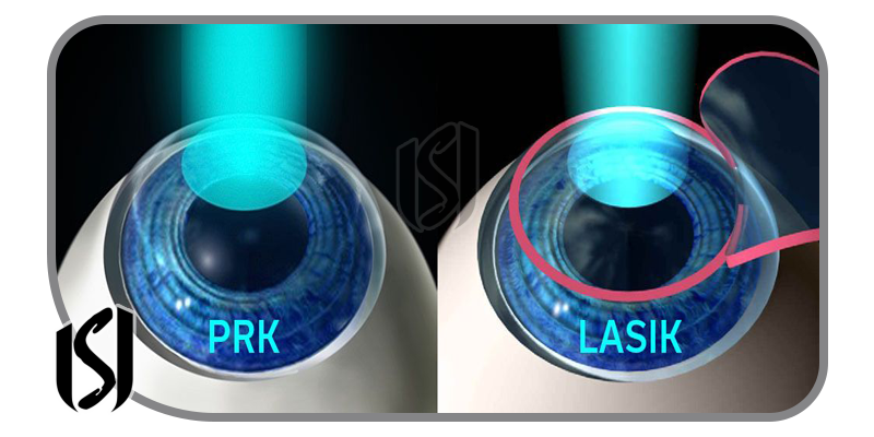 LASIK and PRK Vision Correction Procedures