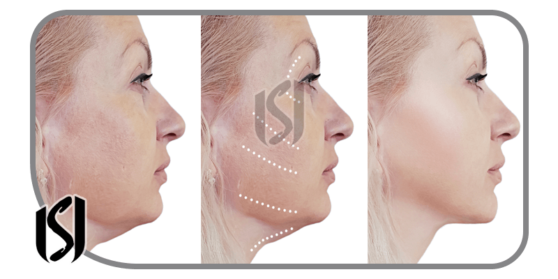 Facelift and Neck Lift with Dermal Fillers in Turkiye
