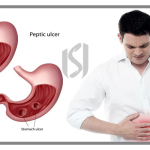 Gastrointestinal Diseases and Treatment of Gastric Ulcers in Turkiye